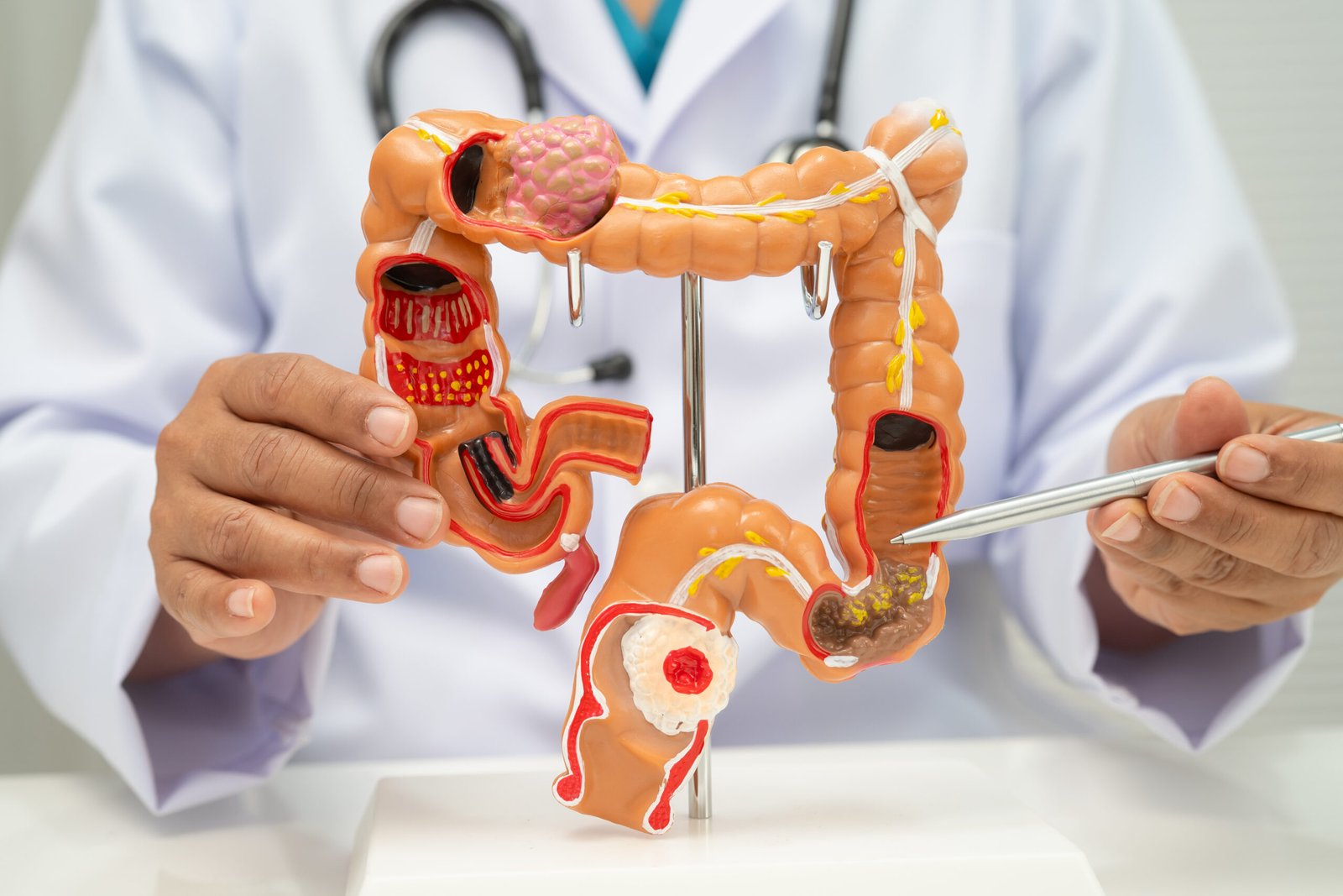 Colon Cancer